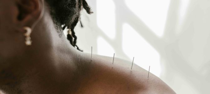 black woman receiving acupuncture on shoulder